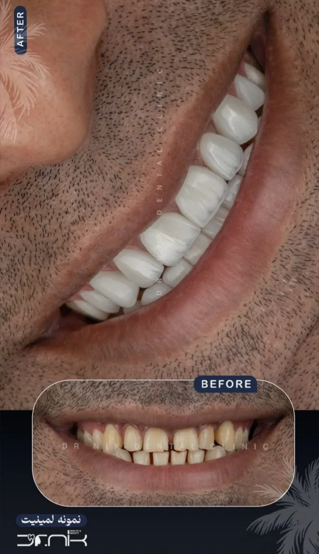 تجميل الأسنان — قبل وبعد، نمونه 1