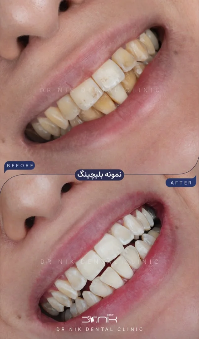 تجميل الأسنان — قبل وبعد، نمونه 2