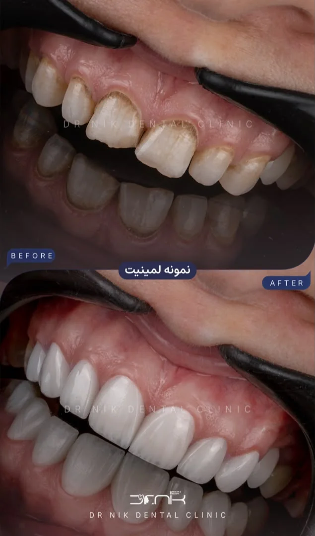 تجميل الأسنان — قبل وبعد، نمونه 3