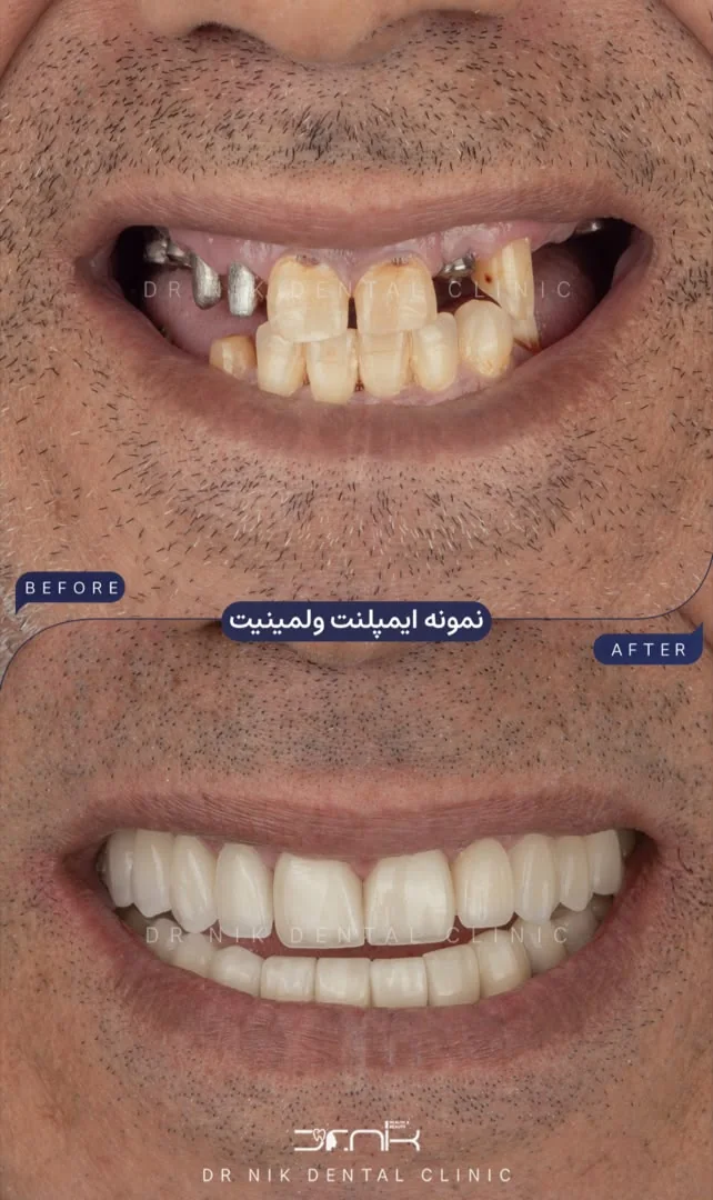 تجميل الأسنان — قبل وبعد، نمونه 4