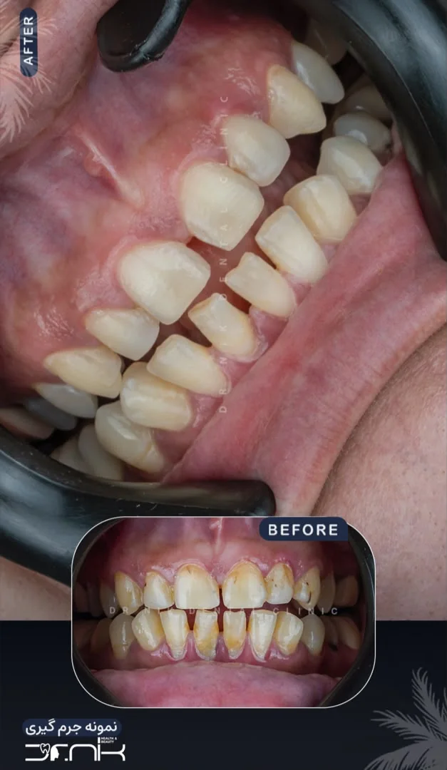 تجميل الأسنان — قبل وبعد، نمونه 5