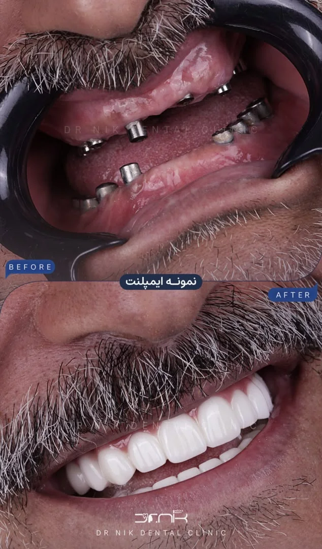 تجميل الأسنان — قبل وبعد، نمونه 6