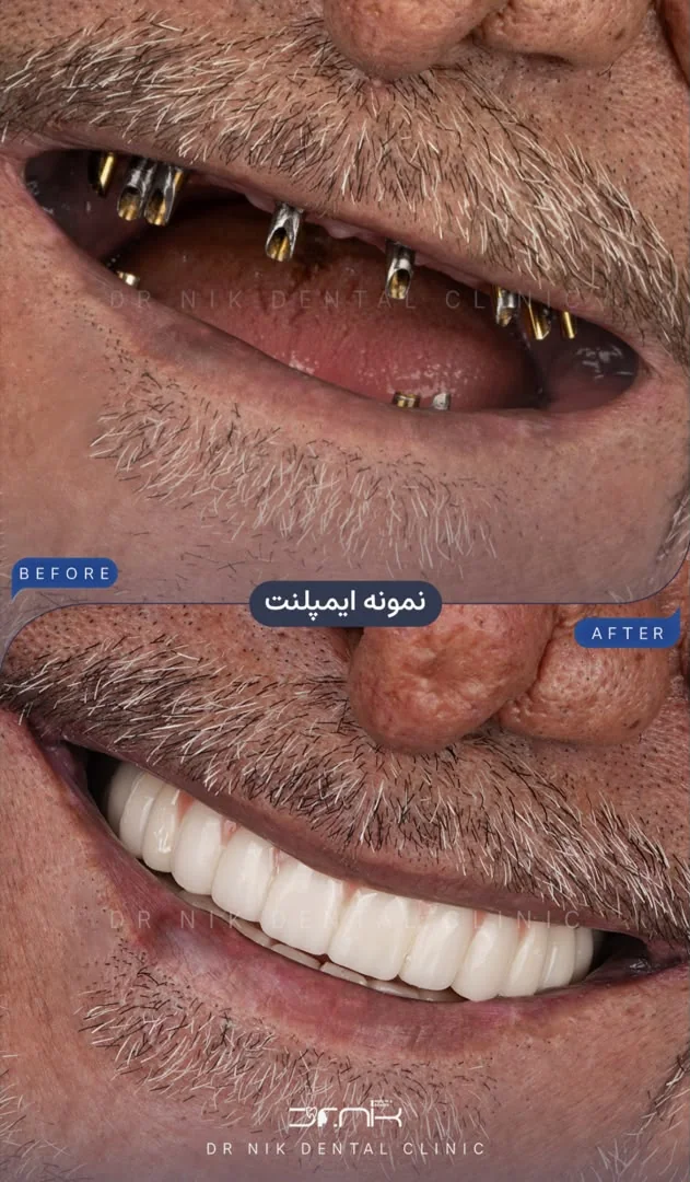 تجميل الأسنان — قبل وبعد، نمونه 7