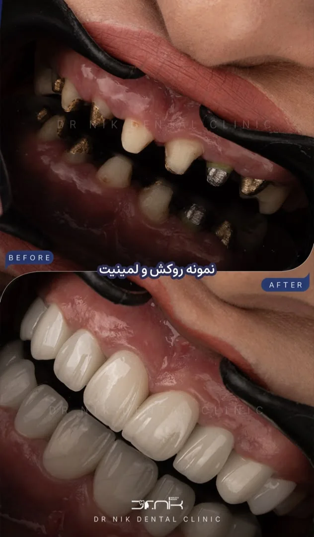 تجميل الأسنان — قبل وبعد، نمونه 8