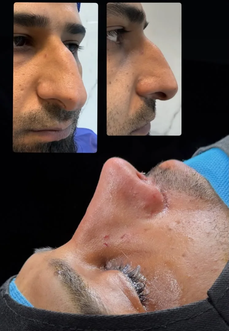 Rhinoplasty before and after — case 1