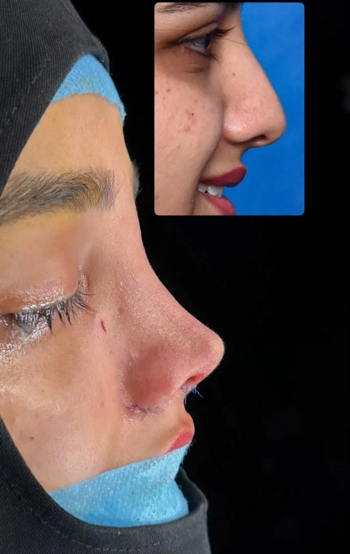 Rhinoplasty before and after — case 2