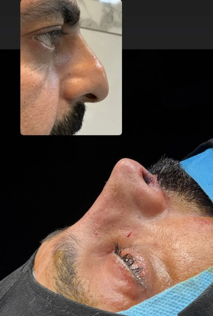 Rhinoplasty before and after — case 3