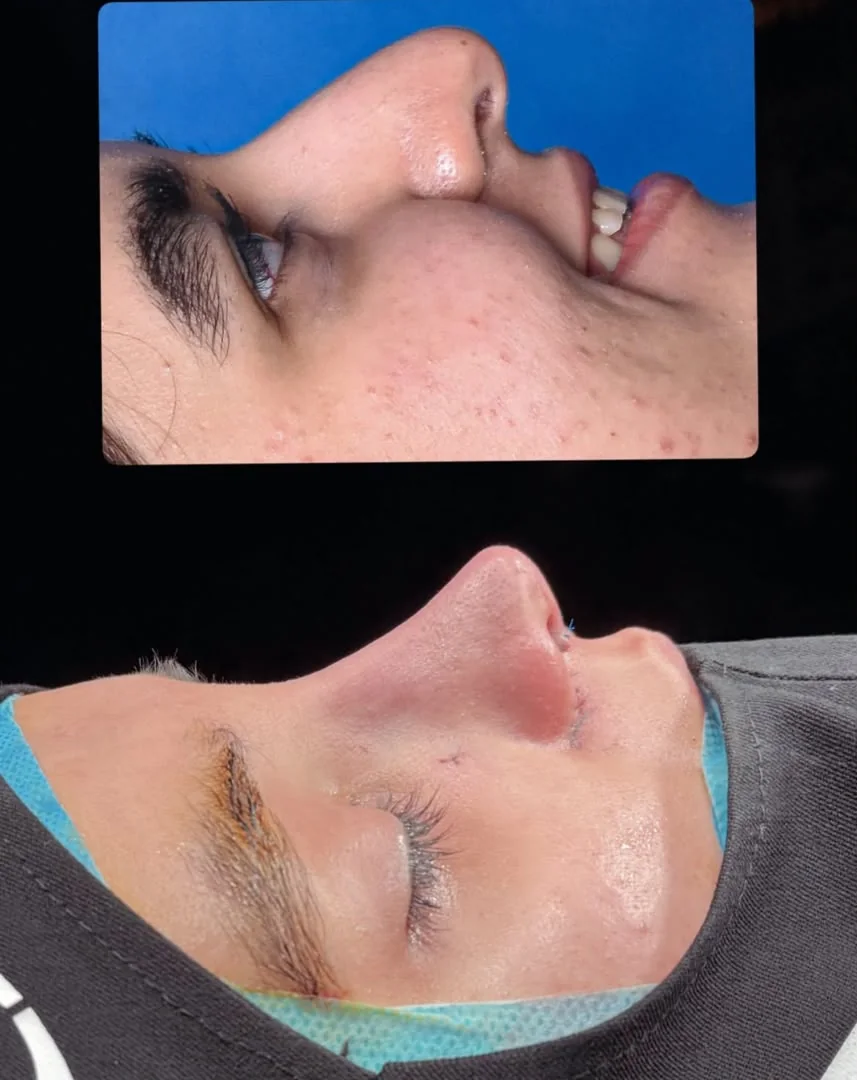 Rhinoplasty before and after — case 4