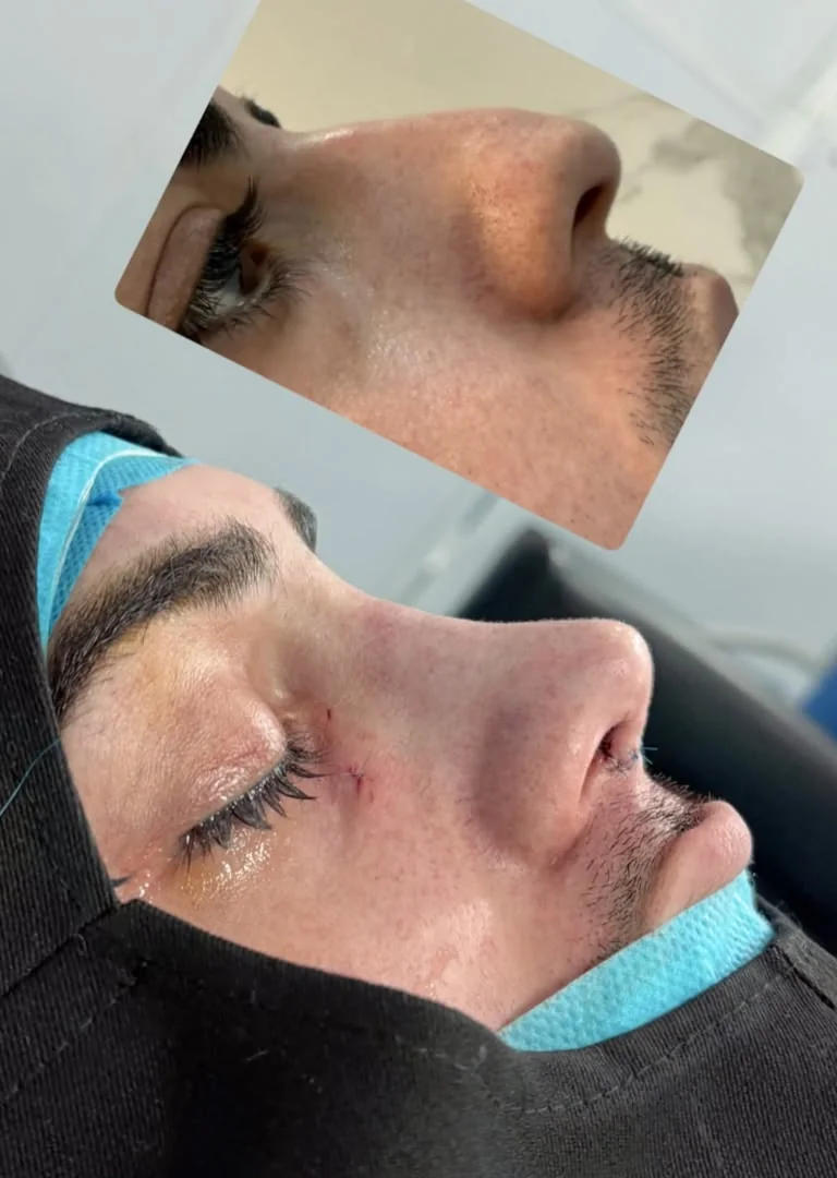Rhinoplasty before and after — case 5