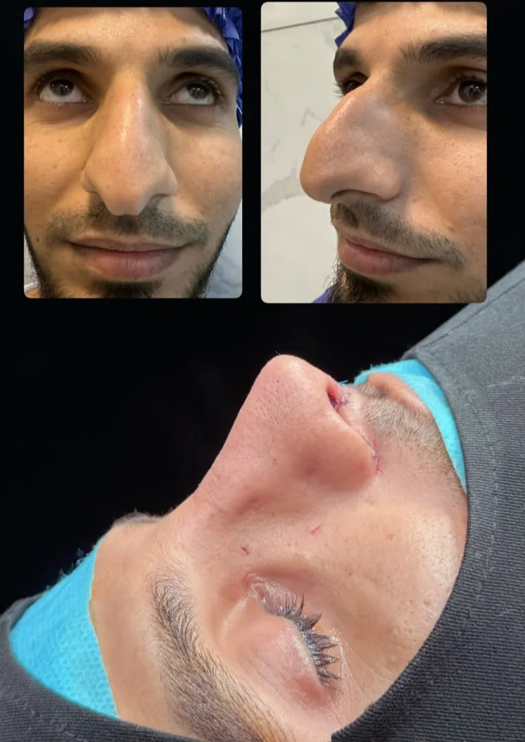 Rhinoplasty before and after — case 6